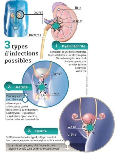 sodomie infection urinaire|Prévenir les risques d’infection urinaire lors de la sodomie